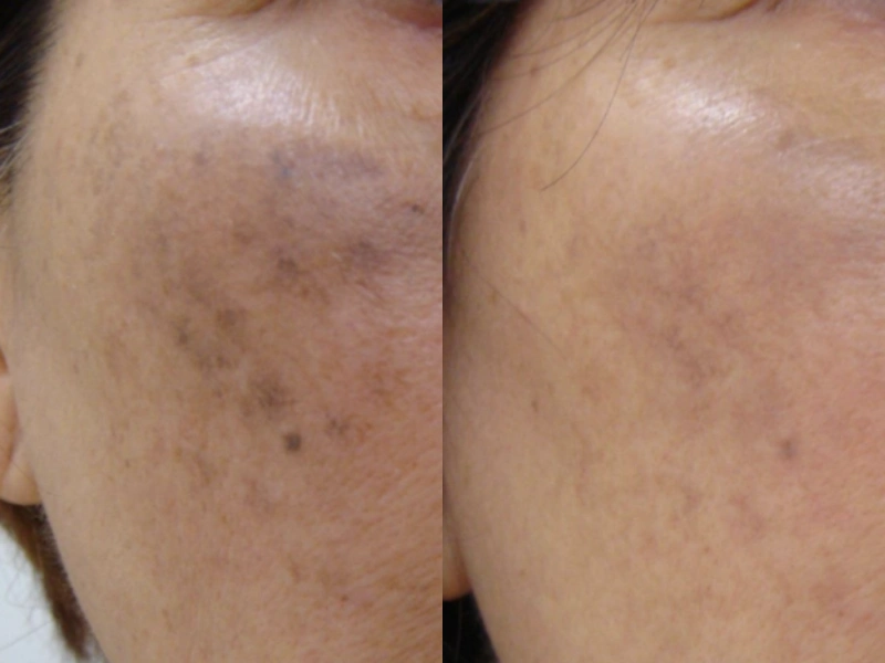 Skinesse Pigmentation Solution Before and After
