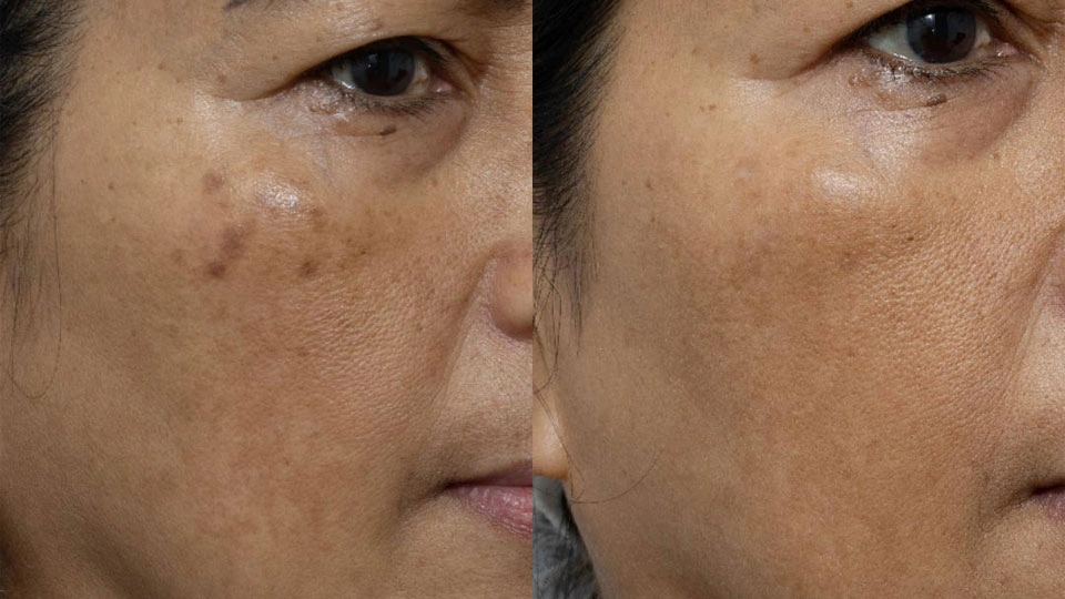 Melasma Treatment Before and After