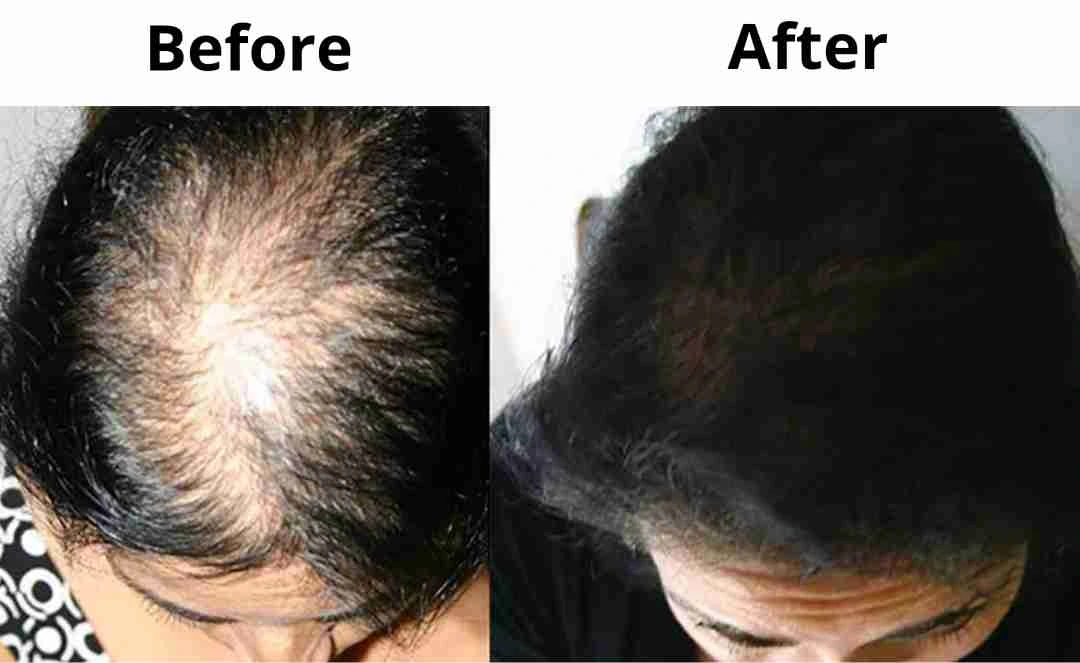 Advanced Hair Regrowth Matrix