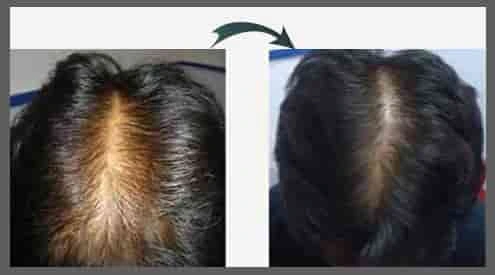 Advanced Hair Regrowth Matrix