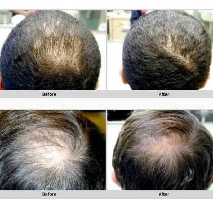Advanced Hair Regrowth Matrix