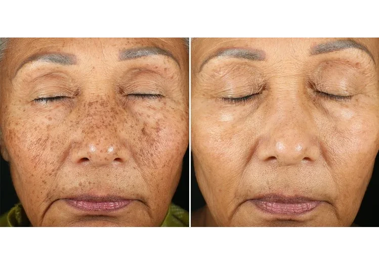 Innovative Hair Regrowth Treatment