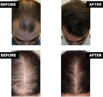 hair-regrowth-theraphy