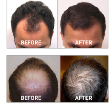 hair-regrowth-theraphy