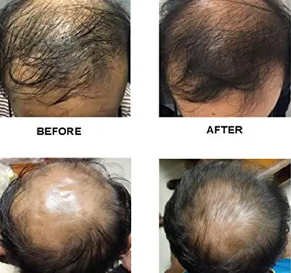 hair-regrowth-theraphy