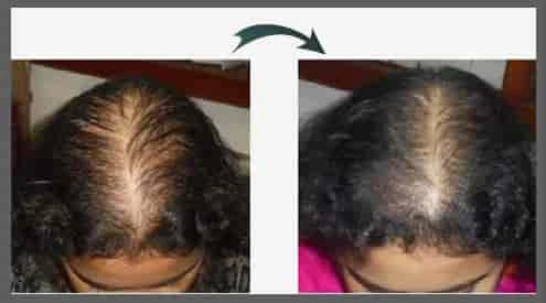 Innovative Hair Regrowth Treatment