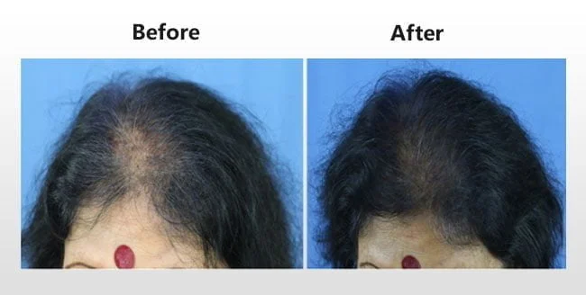 Innovative Hair Regrowth Treatment