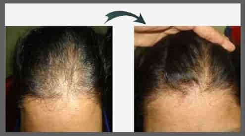 Innovative Hair Regrowth Treatment