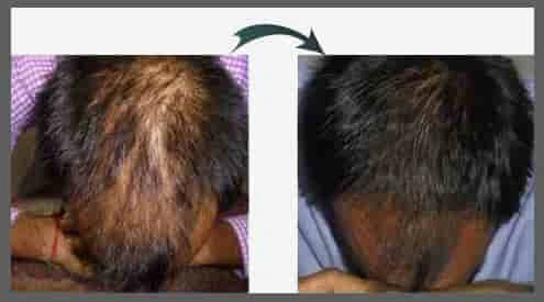Mesotherapy Hair Injection