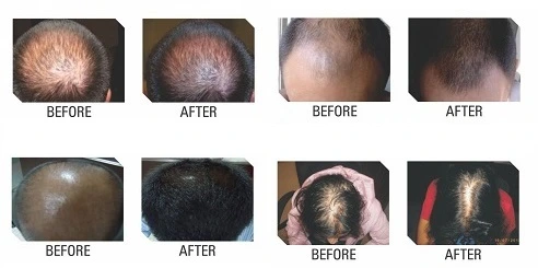 Mesotherapy Hair Injection