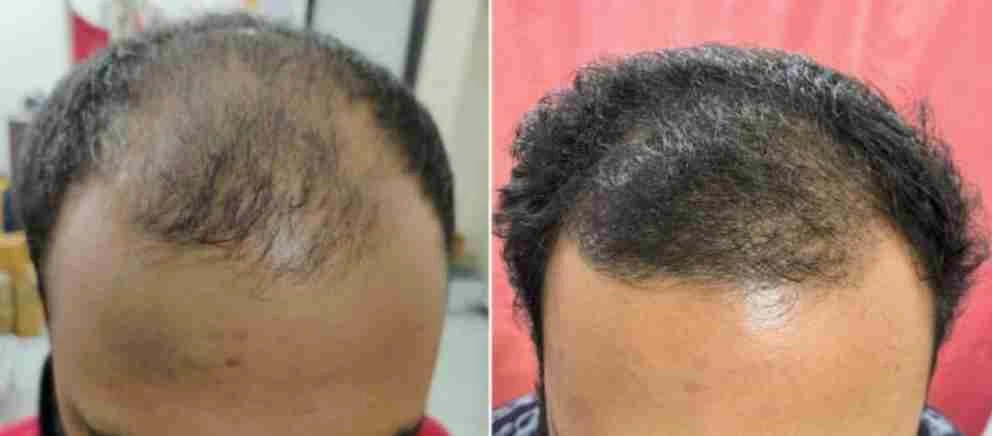 Mesotherapy Hair Injection