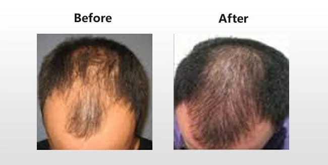 Platelet Rich Plasma Tubes India