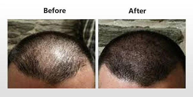 Platelet Rich Plasma Tubes India