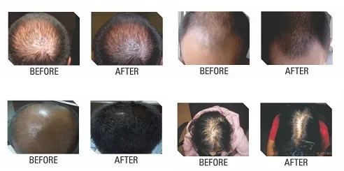 hair-matrix-pre-post